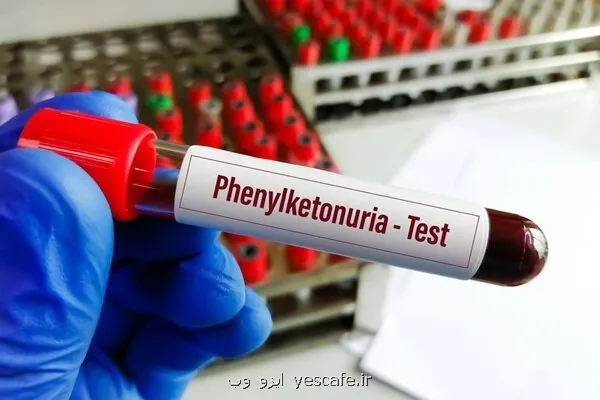 خبر خوش برای بیماران PKU توزیع نان بدون پروتئین